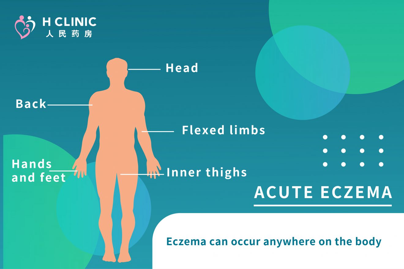 Types Of Eczema H Clinic