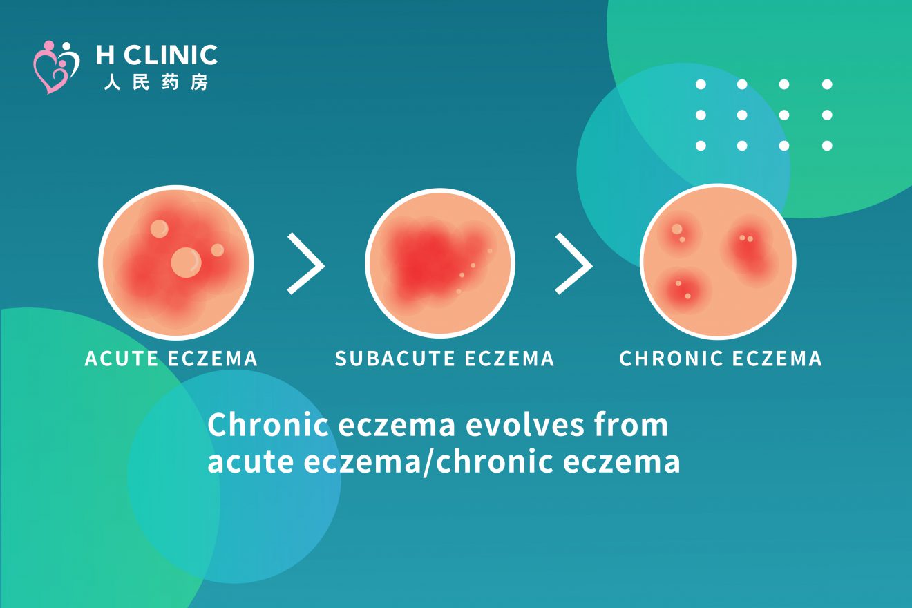 Types Of Eczema H Clinic